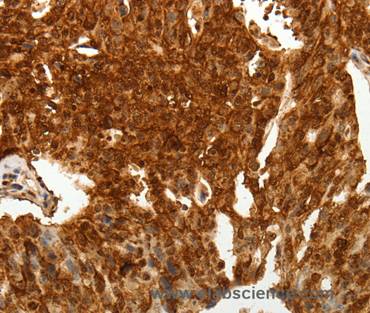 Immunohistochemistry of paraffin-embedded Human lung cancer tissue using TENM3 Polyclonal Antibody at dilution 1:50