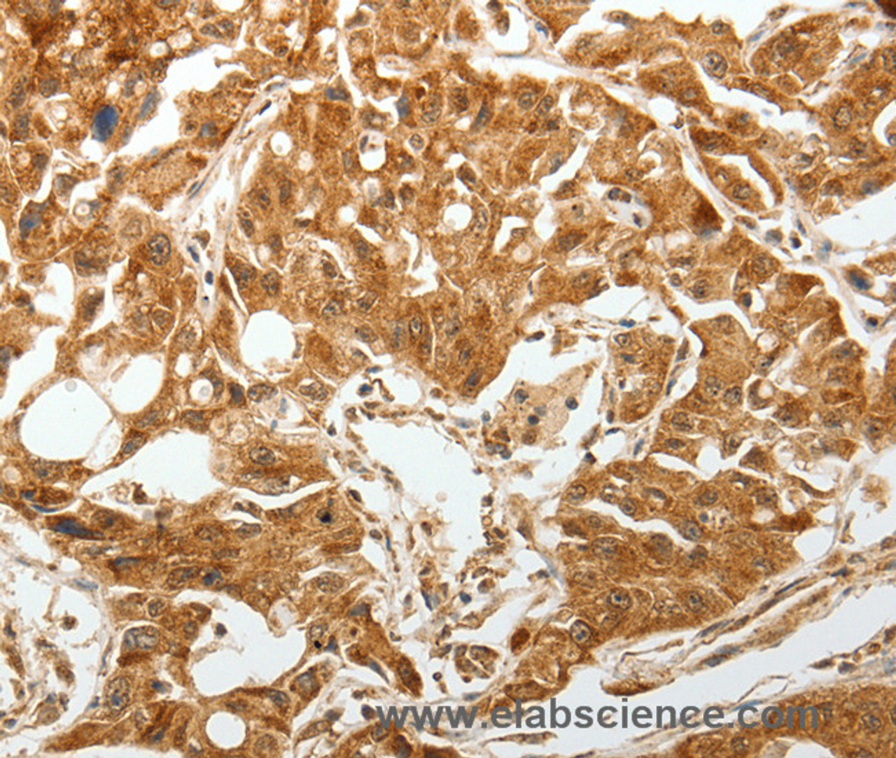 Immunohistochemistry of paraffin-embedded Human lung cancer tissue using TGF β Receptor I Polyclonal Antibody at dilution 1:60