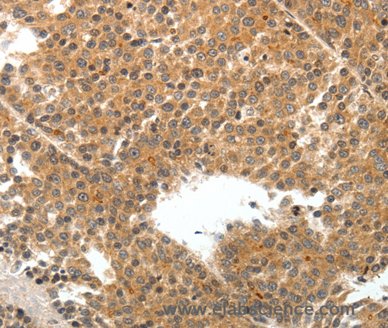 Immunohistochemistry of paraffin-embedded Human liver cancer tissue using TEK Polyclonal Antibody at dilution 1:50