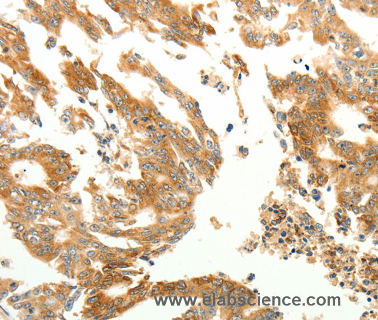 Immunohistochemistry of paraffin-embedded Human gastric cancer using RARRES1 Polyclonal Antibody at dilution of 1:60