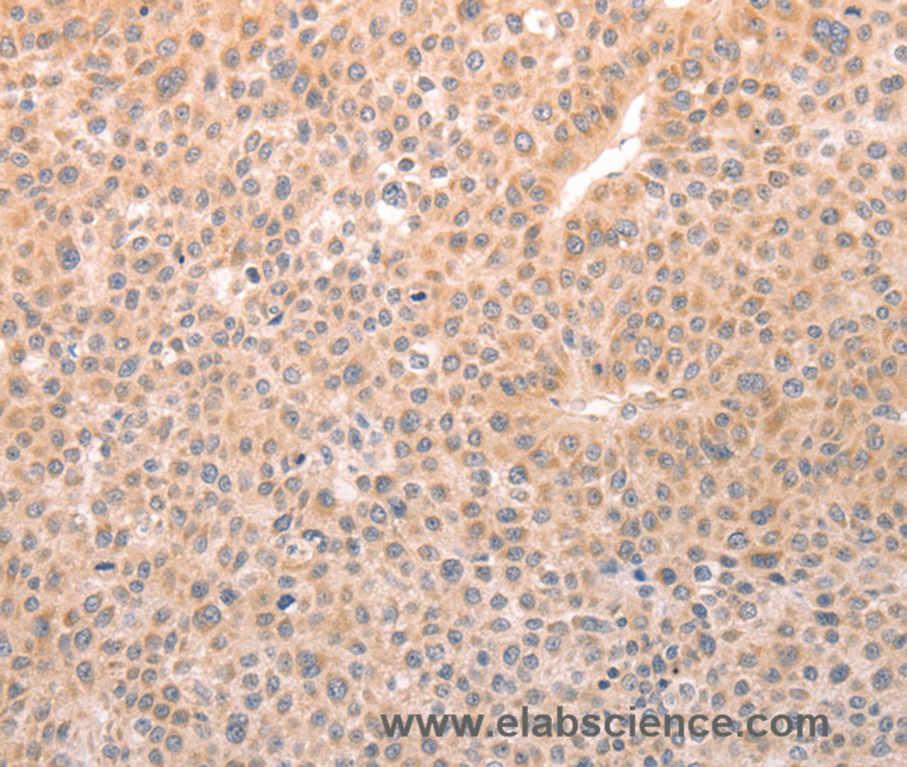 Immunohistochemistry of paraffin-embedded Human liver cancer tissue using TRPC3 Polyclonal Antibody at dilution 1:50