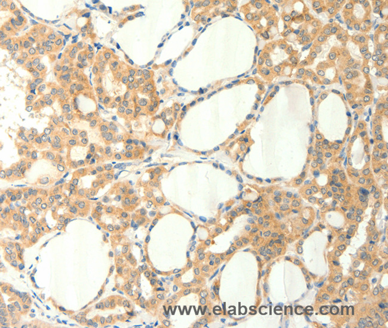 Immunohistochemistry of paraffin-embedded Human thyroid cancer using TRPM5 Polyclonal Antibody at dilution of 1:60