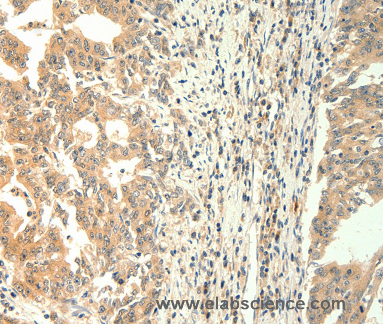 Immunohistochemistry of paraffin-embedded Human gastric cancer using TRPM5 Polyclonal Antibody at dilution of 1:60
