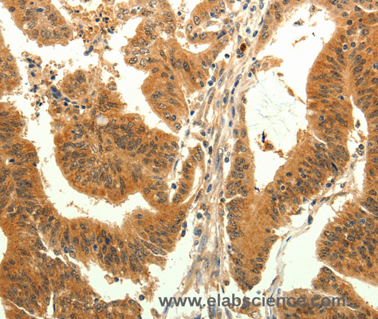 Immunohistochemistry of paraffin-embedded Human colon cancer tissue using TRPM7 Polyclonal Antibody at dilution 1:30