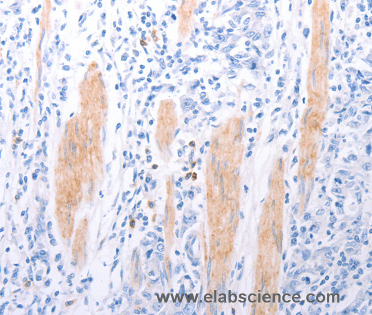 Immunohistochemistry of paraffin-embedded Human gasrtic cancer tissue using LPAR2 Polyclonal Antibody at dilution 1:40