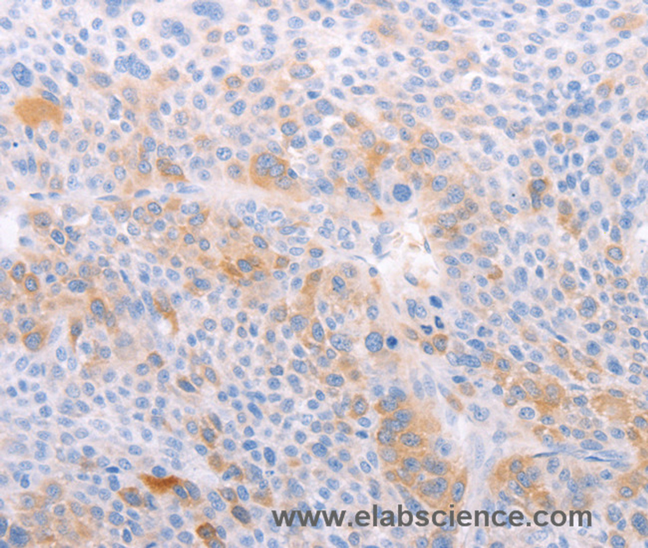 Immunohistochemistry of paraffin-embedded Human liver cancer using EDG6 Polyclonal Antibody at dilution of 1:40