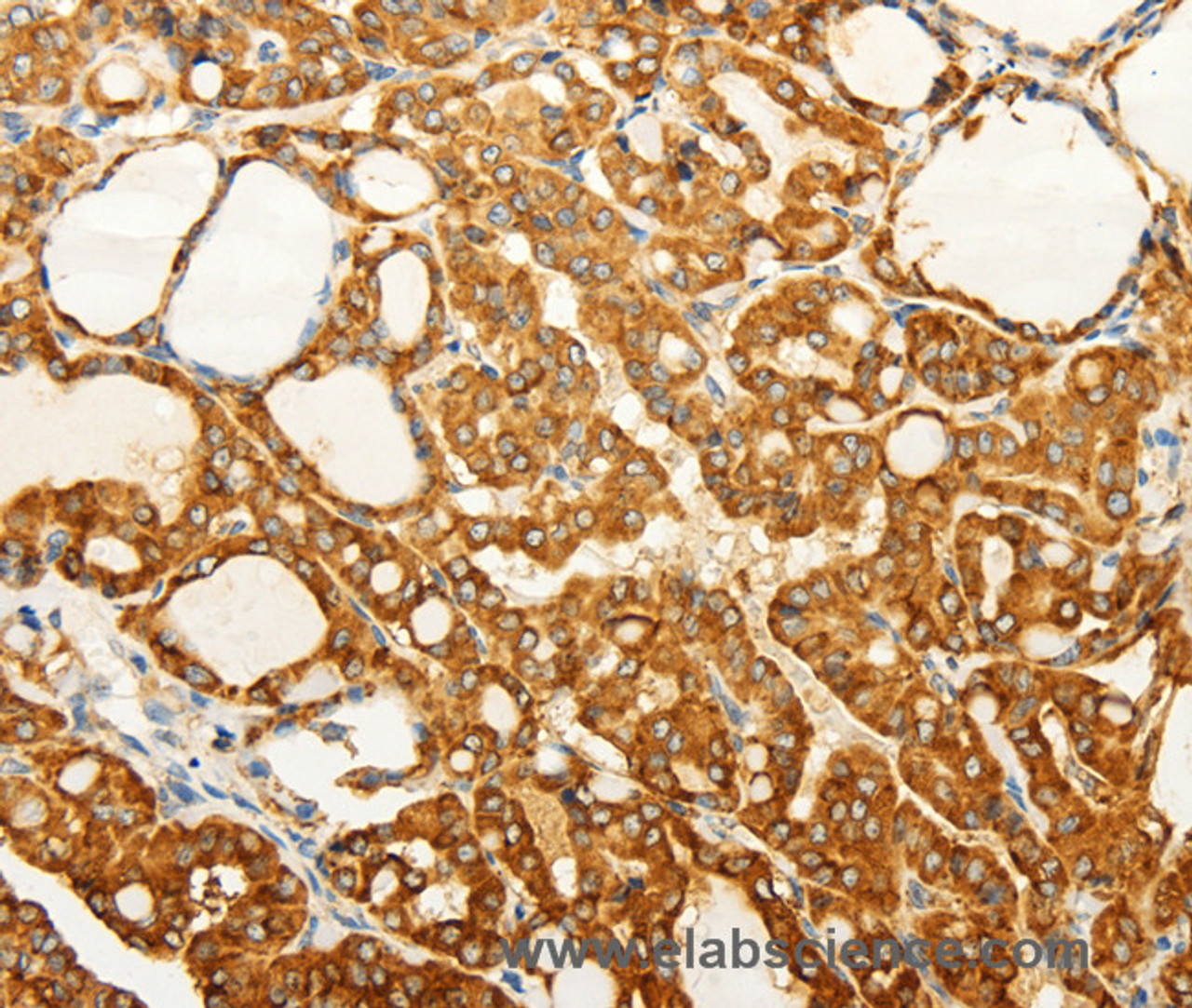 Immunohistochemistry of paraffin-embedded Human thyroid cancer tissue using FZD6 Polyclonal Antibody at dilution 1:60