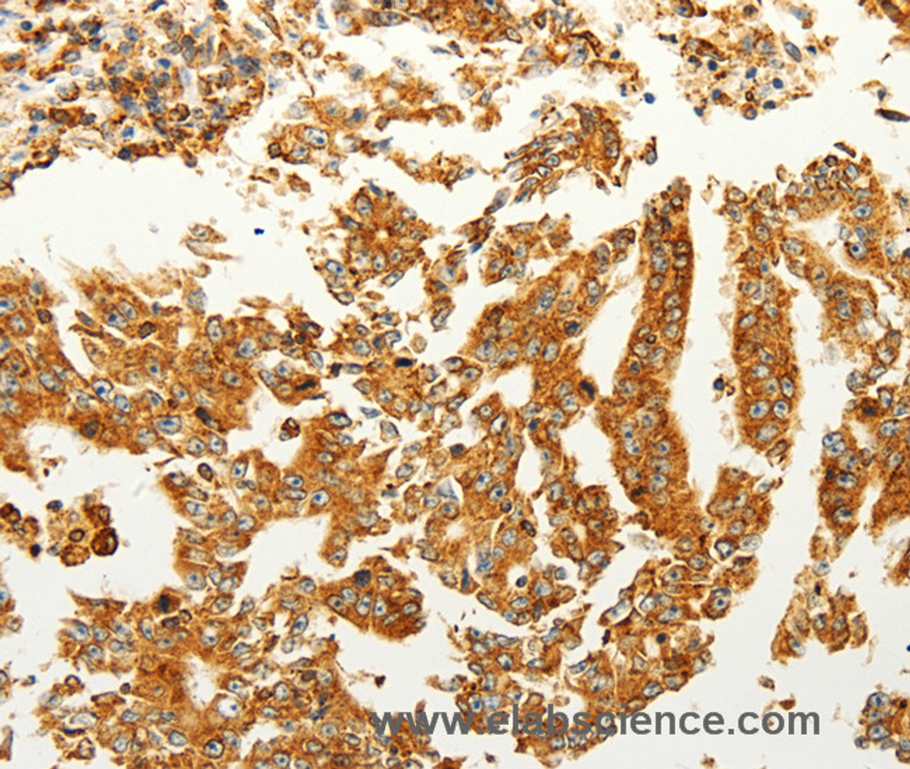 Immunohistochemistry of paraffin-embedded Human gastric cancer tissue using FZD6 Polyclonal Antibody at dilution 1:60