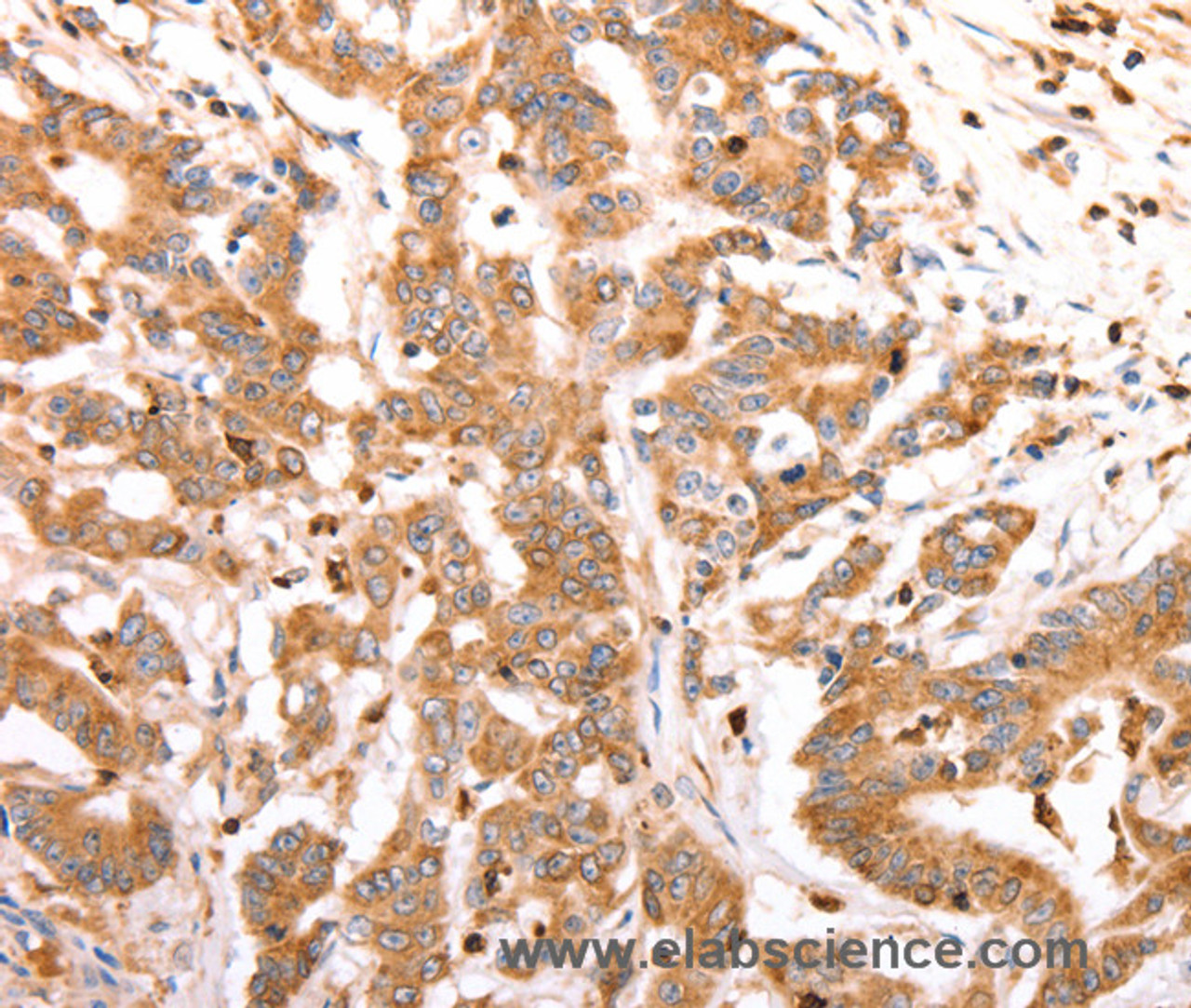 Immunohistochemistry of paraffin-embedded Human colon cancer tissue using CELSR2 Polyclonal Antibody at dilution 1:50