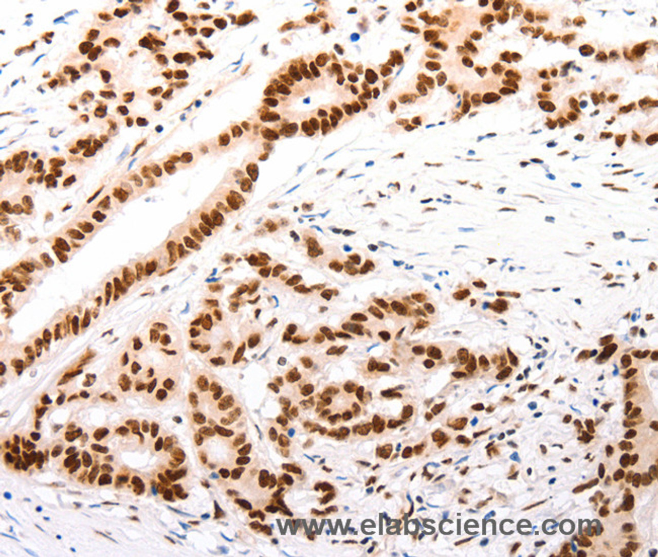 Immunohistochemistry of paraffin-embedded Human colon cancer tissue using CASP9 (active) Polyclonal Antibody at dilution 1:80