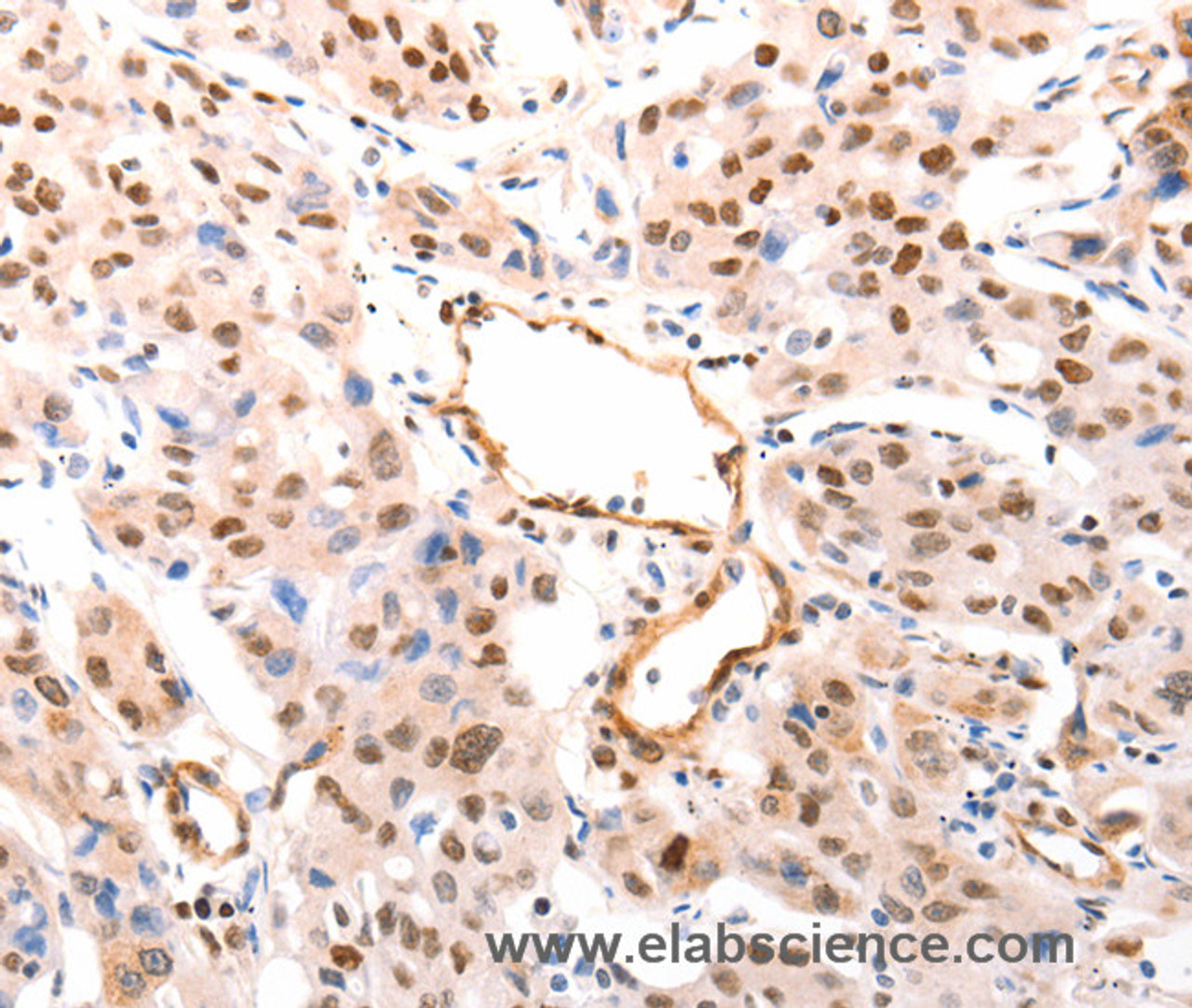 Immunohistochemistry of paraffin-embedded Human lung cancer tissue using CASP9 (active) Polyclonal Antibody  at dilution 1:80