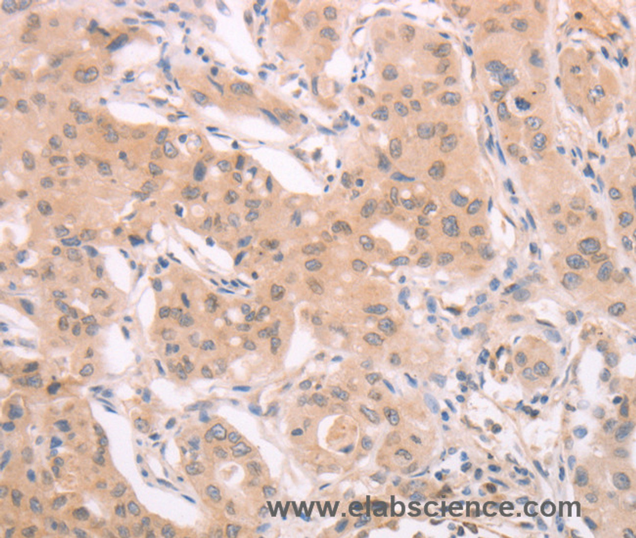 Immunohistochemistry of paraffin-embedded Human breast cancer using ADAM11 Polyclonal Antibody at dilution of 1:40