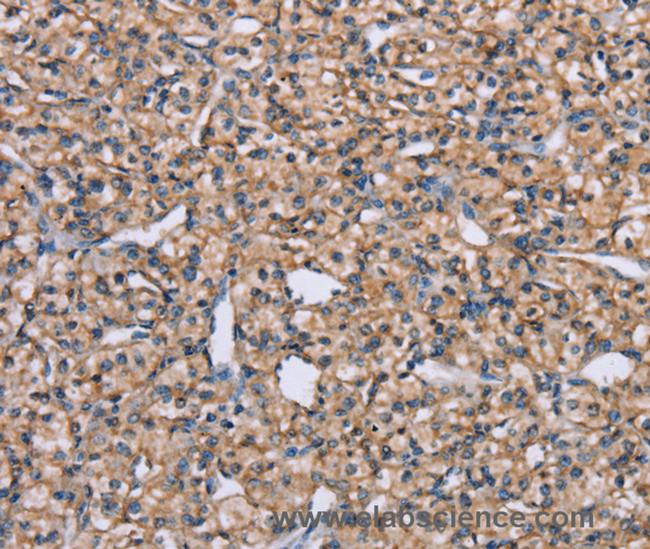 Immunohistochemistry of paraffin-embedded Human prostate cancer tissue using ADAM29 Polyclonal Antibody at dilution 1:40