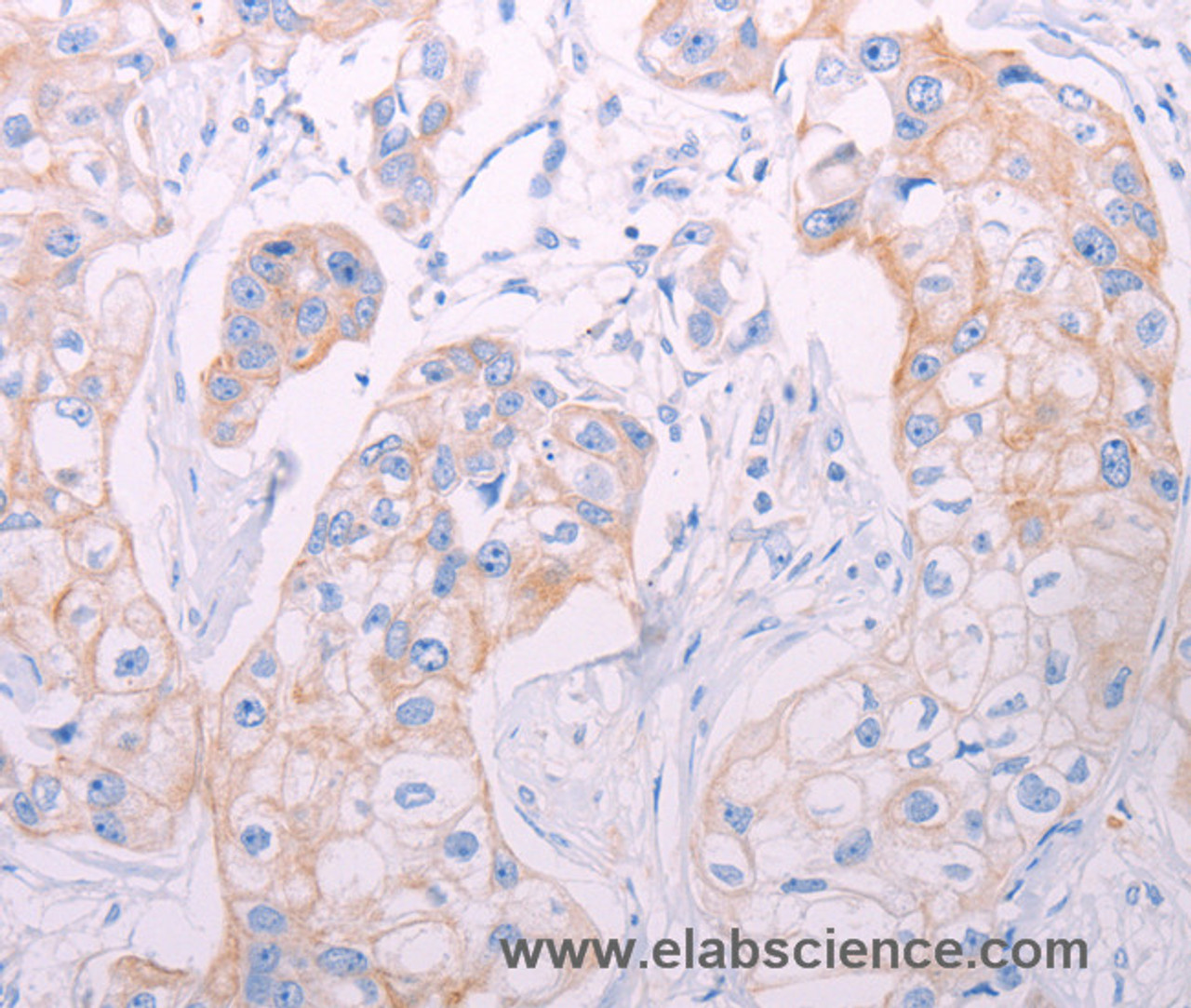 Immunohistochemistry of paraffin-embedded Human breast cancer tissue using ADAMTS14 Polyclonal Antibody at dilution 1:50