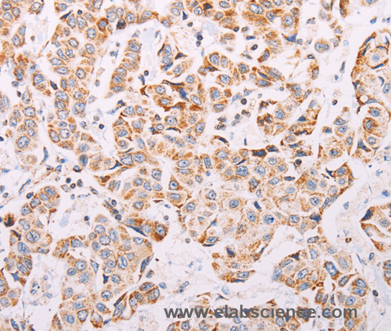 Immunohistochemistry of paraffin-embedded Human breast cancer tissue using ADAMTS16 Polyclonal Antibody at dilution 1:50