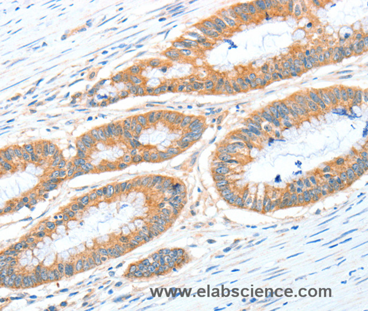 Immunohistochemistry of paraffin-embedded Human colon cancer tissue using ALDH1A2 Polyclonal Antibody at dilution 1:30