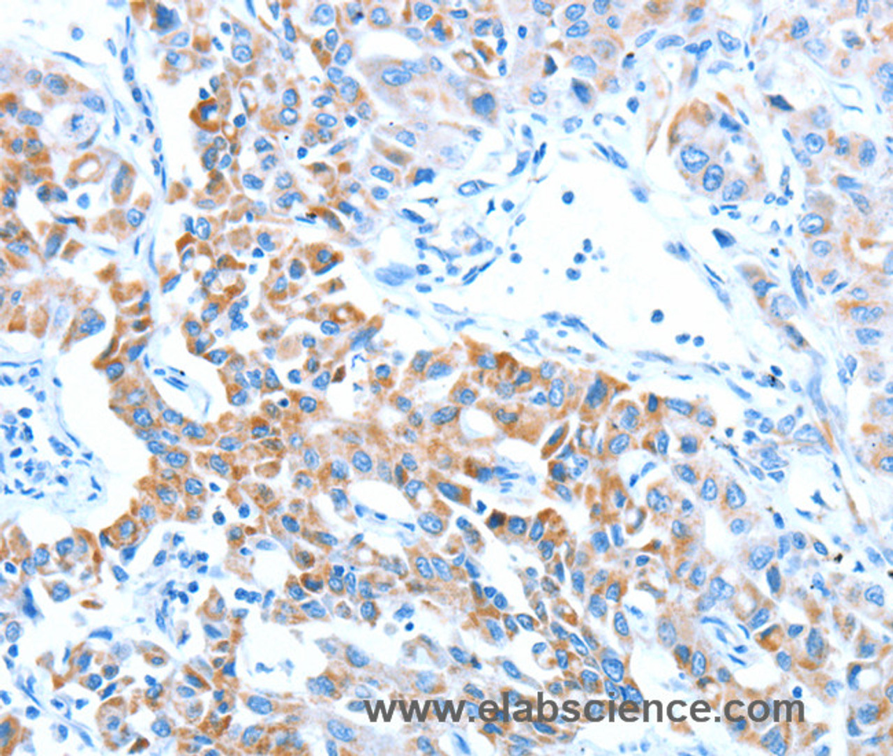 Immunohistochemistry of paraffin-embedded Human lung cancer tissue using ALDH5A1 Polyclonal Antibody at dilution 1:60