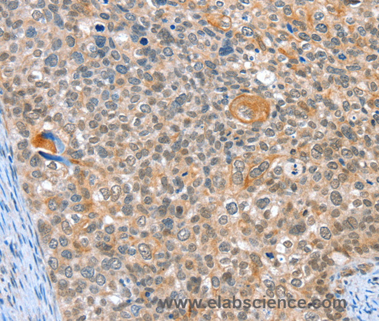 Immunohistochemistry of paraffin-embedded Human cervical cancer using ALDOB Polyclonal Antibody at dilution of 1:40