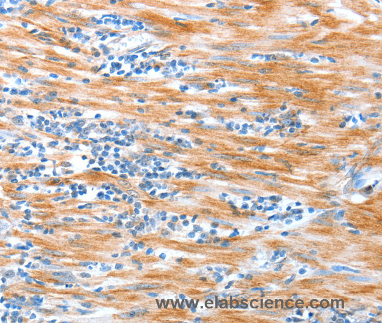 Immunohistochemistry of paraffin-embedded Human esophagus cancer using ALDOB Polyclonal Antibody at dilution of 1:40
