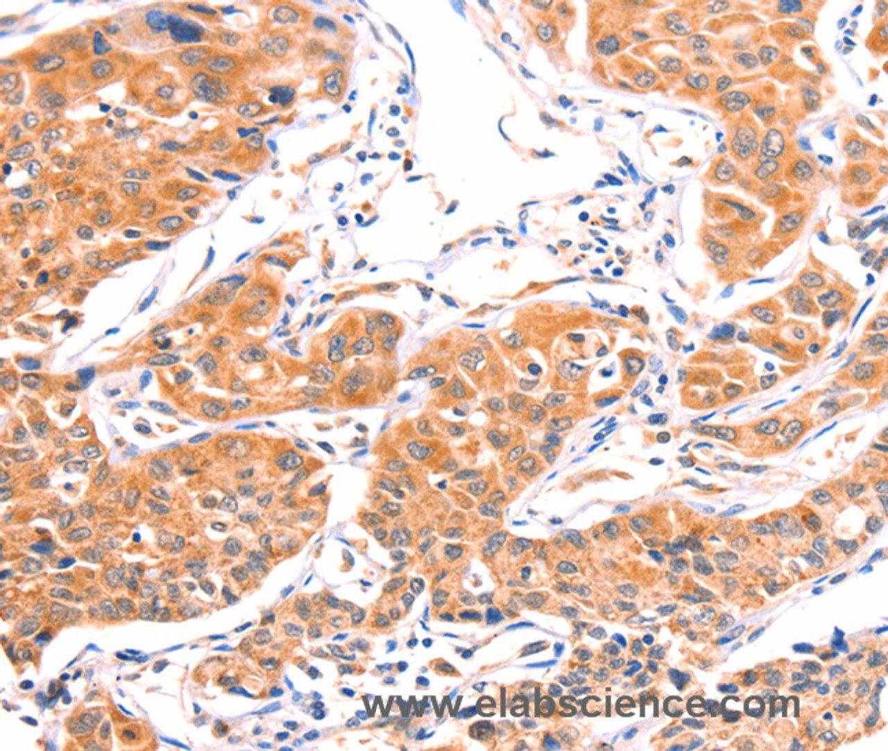 Immunohistochemistry of paraffin-embedded Human lung cancer using AMPD1 Polyclonal Antibody at dilution of 1:80