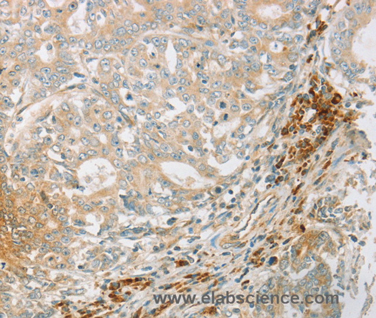 Immunohistochemistry of paraffin-embedded Human gastric cancer tissue using AMPK alpha1 Polyclonal Antibody at dilution 1:70