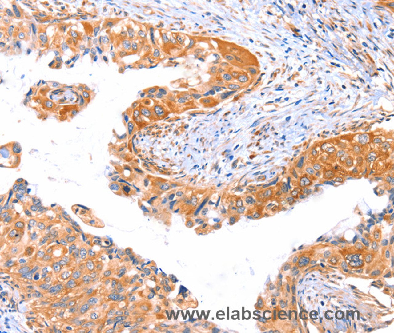 Immunohistochemistry of paraffin-embedded Human cervical cancer tissue using AP1B1 Polyclonal Antibody at dilution 1:70
