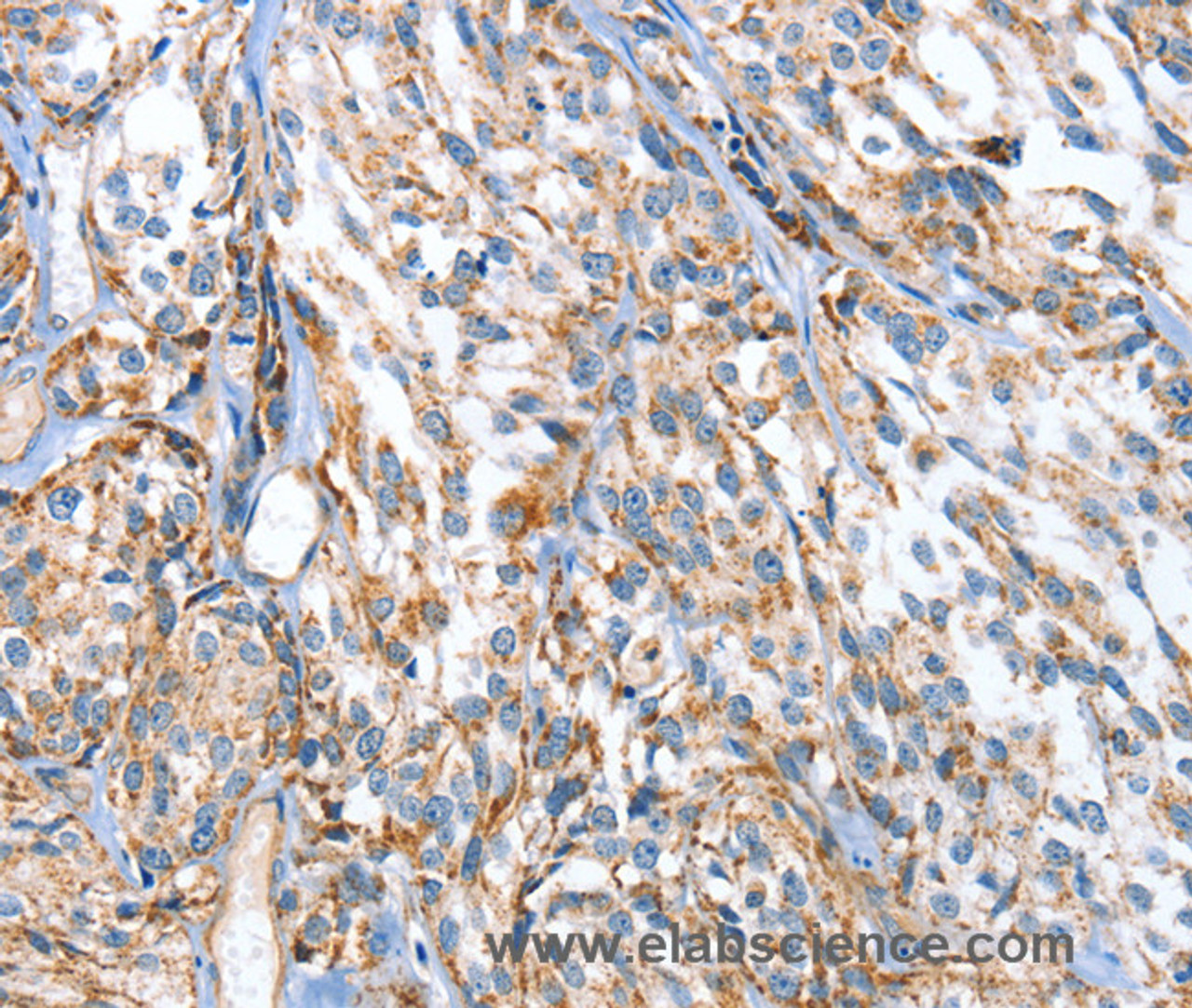 Immunohistochemistry of paraffin-embedded Human esophagus cancer using APOBEC3D Polyclonal Antibody at dilution of 1:80