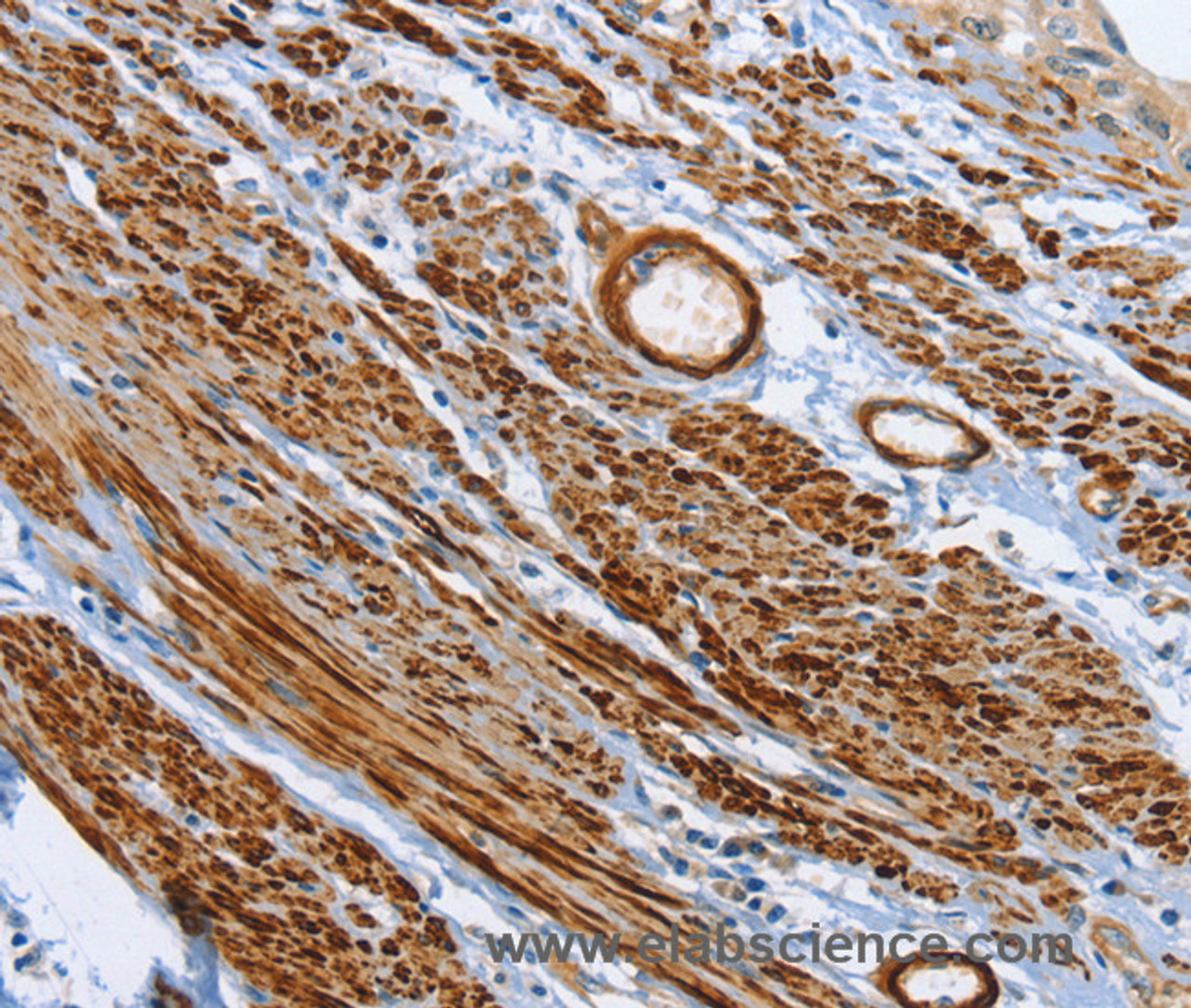 Immunohistochemistry of paraffin-embedded Human cervical cancer tissue using SHROOM2 Polyclonal Antibody at dilution 1:50