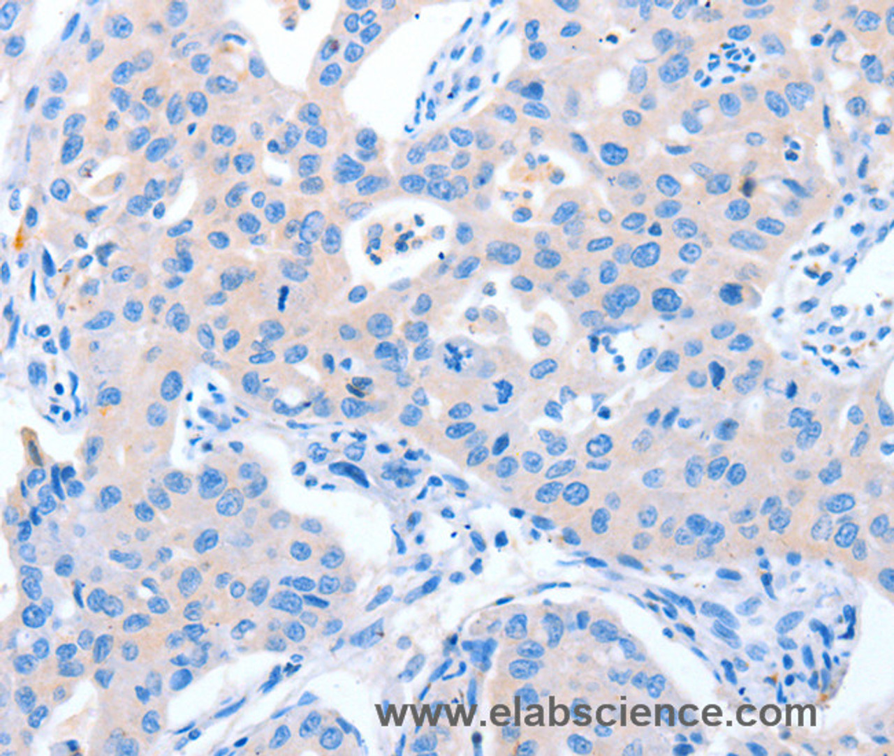 Immunohistochemistry of paraffin-embedded Human lung cancer tissue using NUAK1 Polyclonal Antibody at dilution 1:60