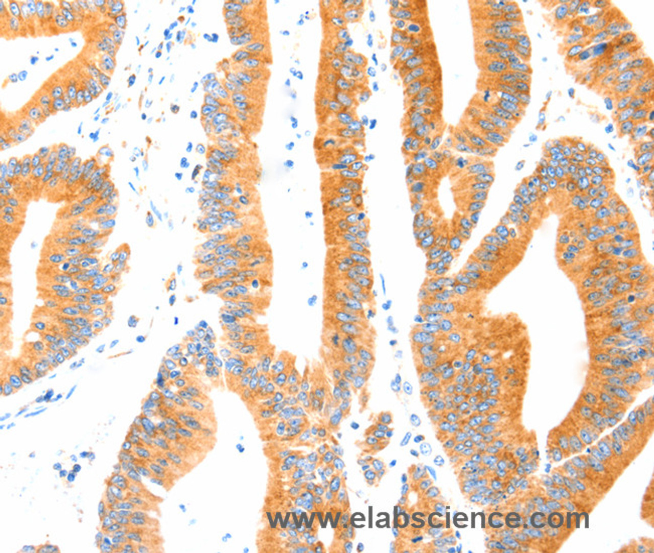 Immunohistochemistry of paraffin-embedded Human colon cancer tissue using MANF Polyclonal Antibody at dilution 1:70