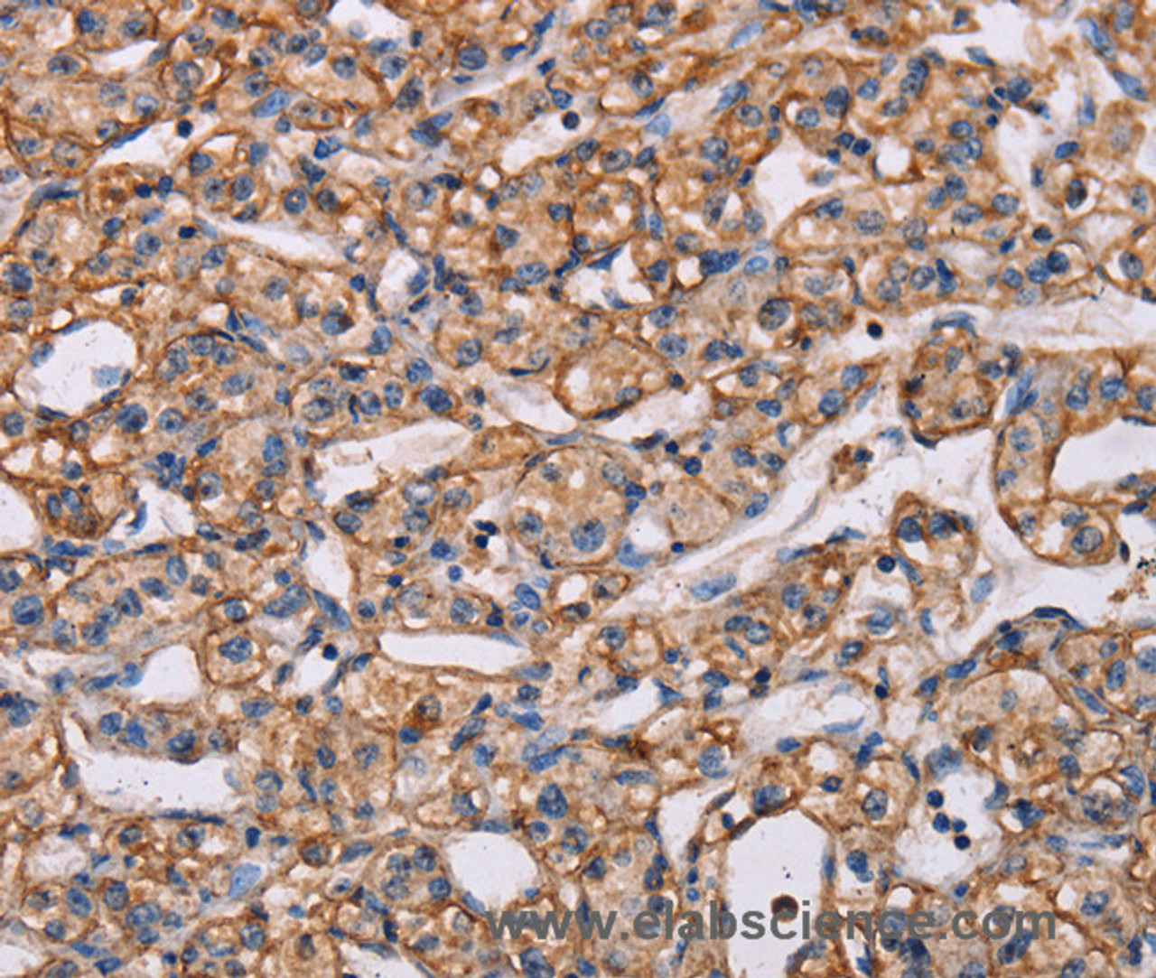 Immunohistochemistry of paraffin-embedded Human prostate cancer tissue using ARAP1 Polyclonal Antibody at dilution 1:40