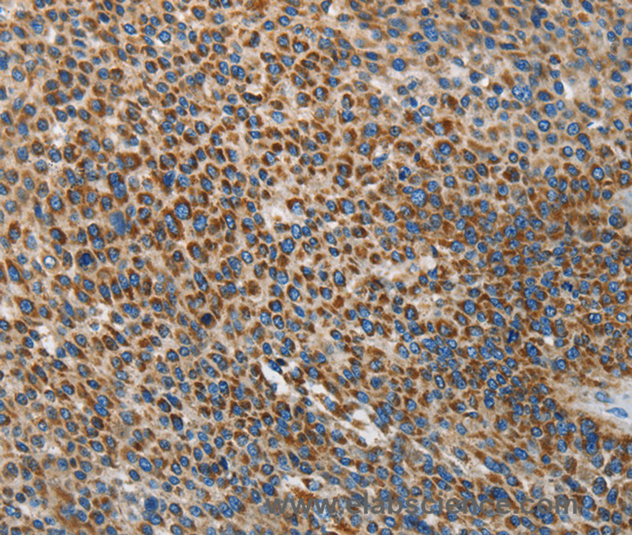 Immunohistochemistry of paraffin-embedded Human liver cancer using UPF1 Polyclonal Antibody at dilution of 1:35