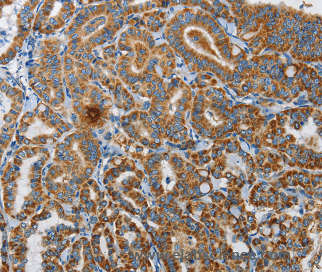 Immunohistochemistry of paraffin-embedded Human thyroid cancer using UPF1 Polyclonal Antibody at dilution of 1:35
