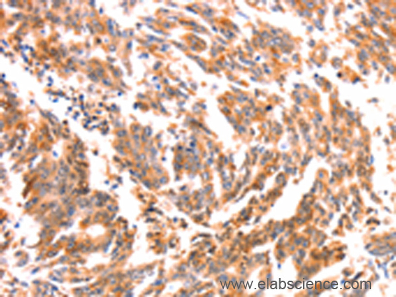 Immunohistochemistry of paraffin-embedded Human gasrtic cancer tissue using NES Polyclonal Antibody at dilution 1:30