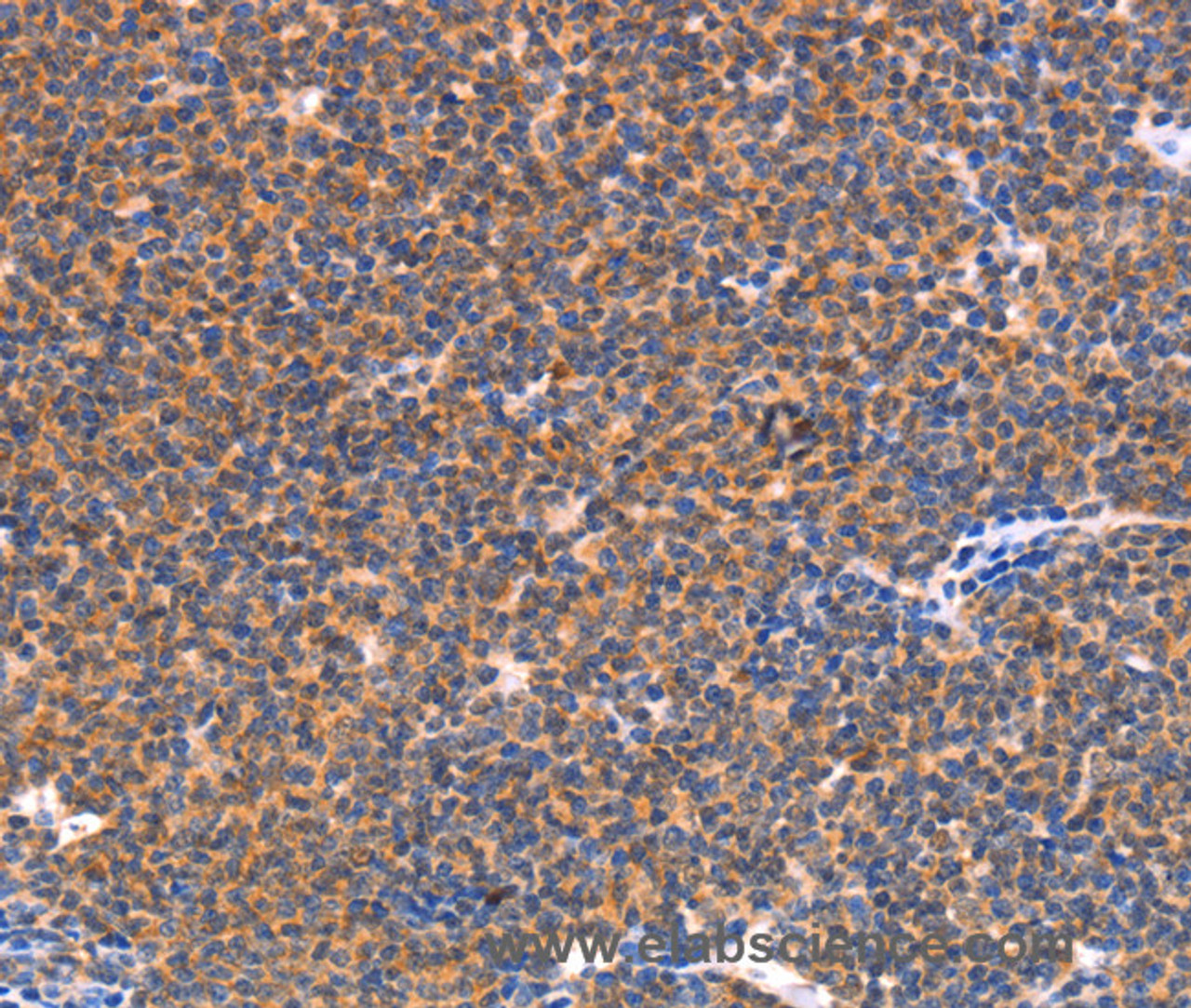 Immunohistochemistry of paraffin-embedded Human lymphoma tissue using NES Polyclonal Antibody at dilution 1:30