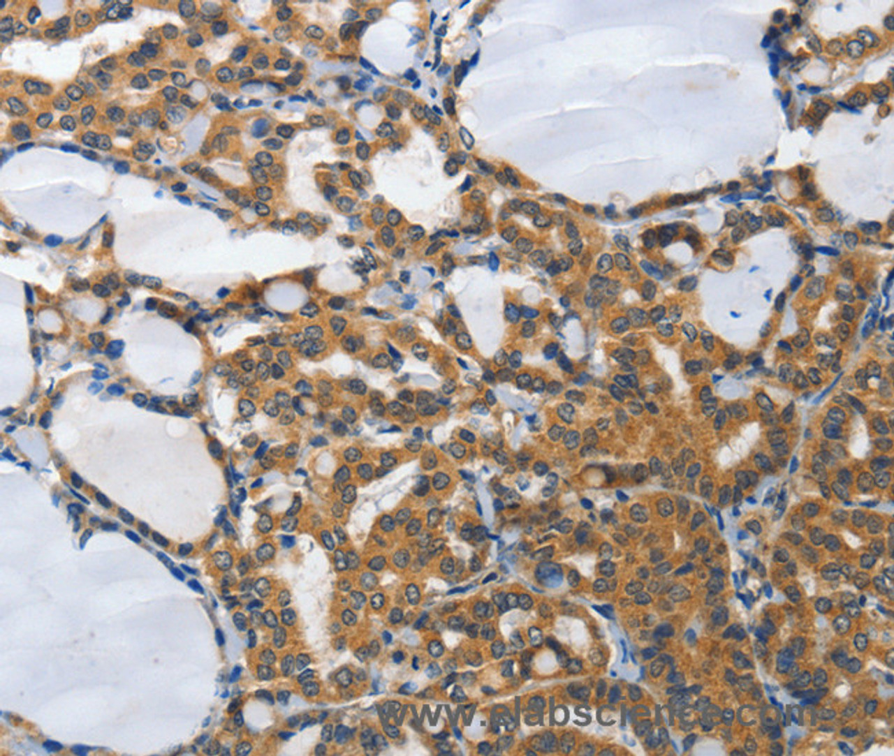 Immunohistochemistry of paraffin-embedded Human thyroid cancer tissue using PIAS2 Polyclonal Antibody at dilution 1:70