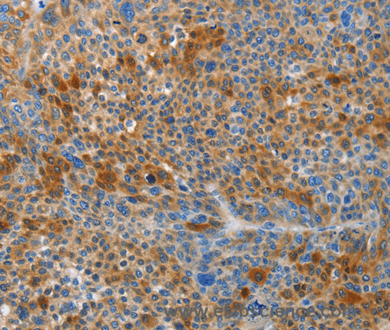 Immunohistochemistry of paraffin-embedded Human liver cancer tissue using HTRA3 Polyclonal Antibody at dilution 1:45