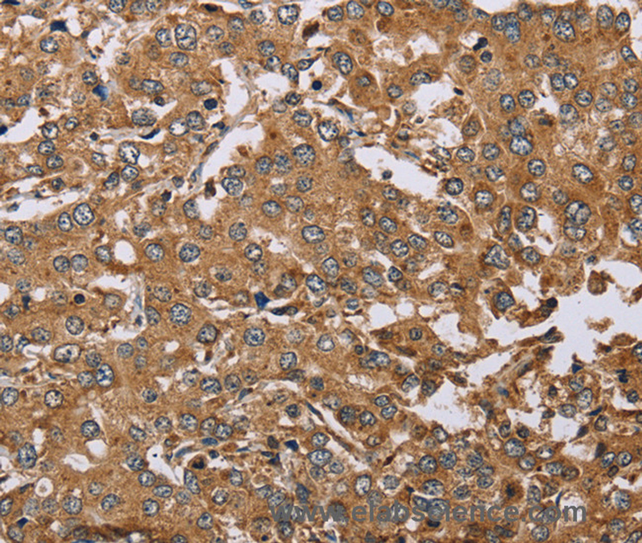 Immunohistochemistry of paraffin-embedded Human liver cancer using DDAH1 Polyclonal Antibody at dilution of 1:50