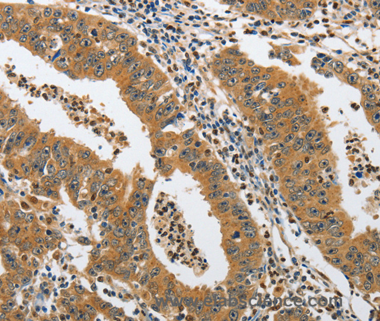 Immunohistochemistry of paraffin-embedded Human gastric cancer tissue using PIK3R3 Polyclonal Antibody at dilution 1:45