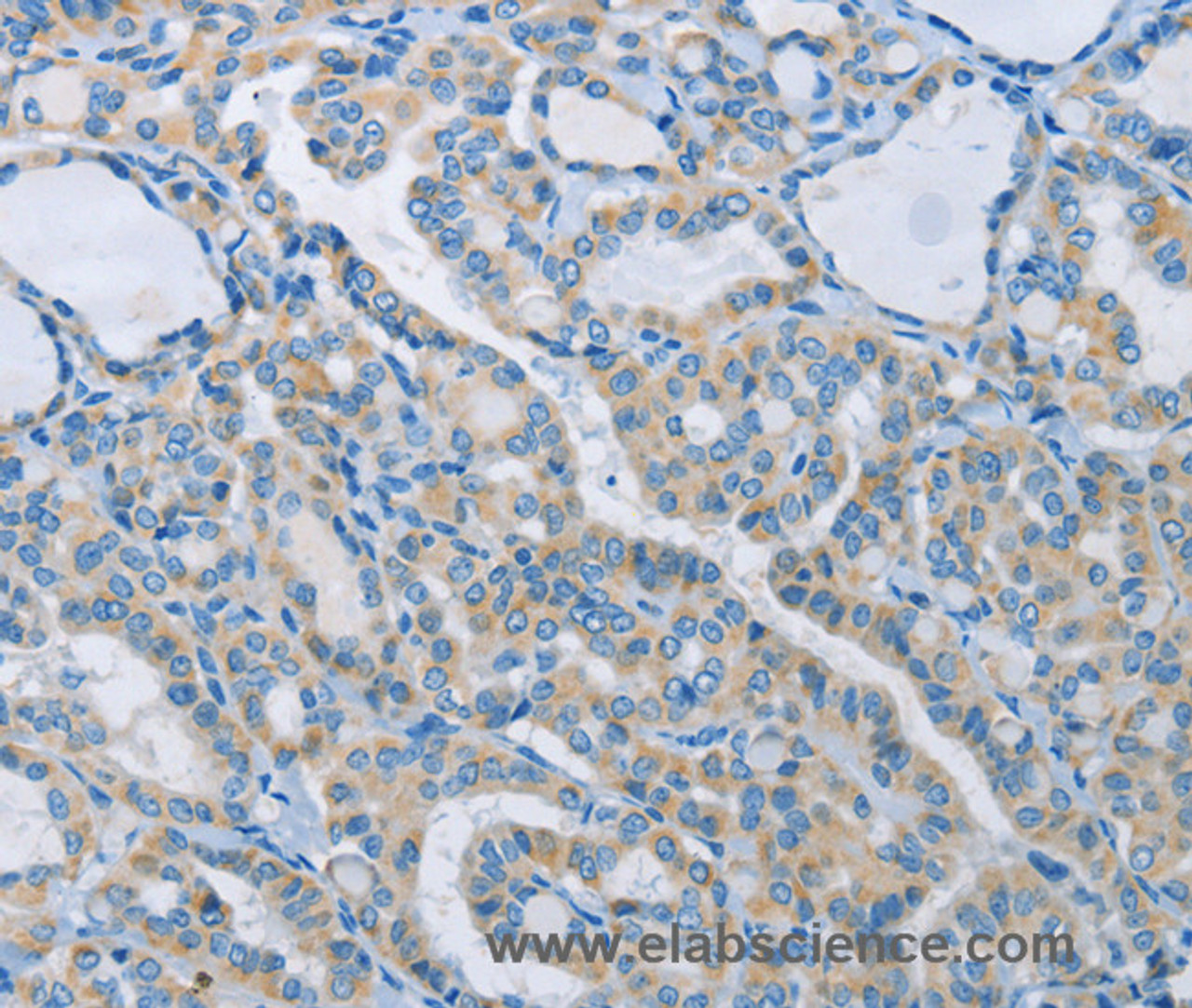 Immunohistochemistry of paraffin-embedded Human thyroid cancer tissue using NEK5 Polyclonal Antibody at dilution 1:60