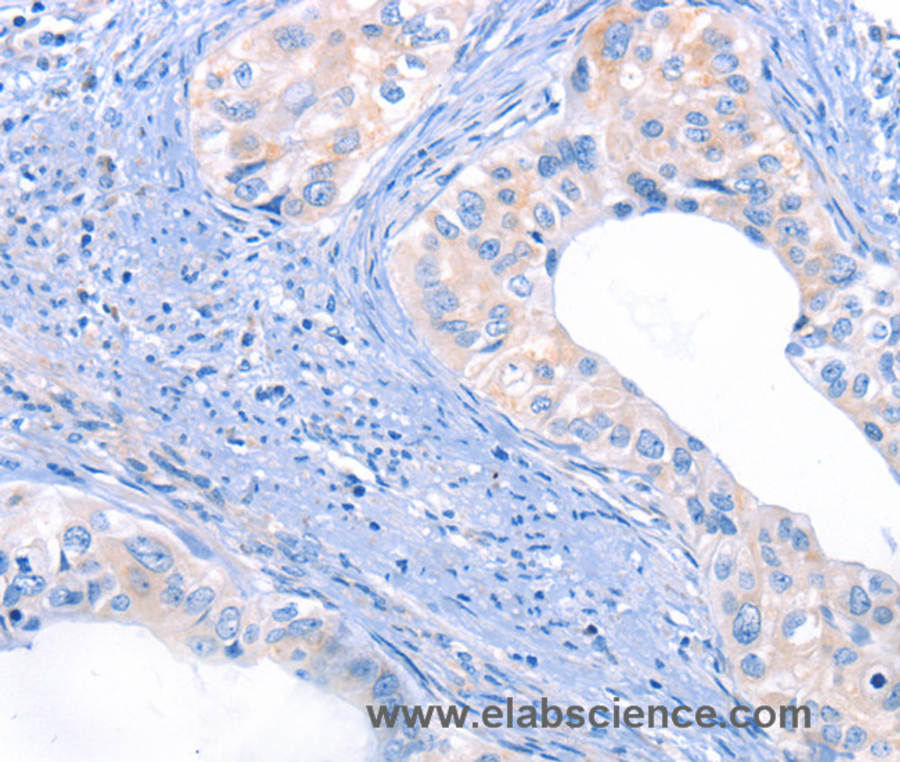 Immunohistochemistry of paraffin-embedded Human cervical cancer using THBS1 Polyclonal Antibody at dilution of 1:50