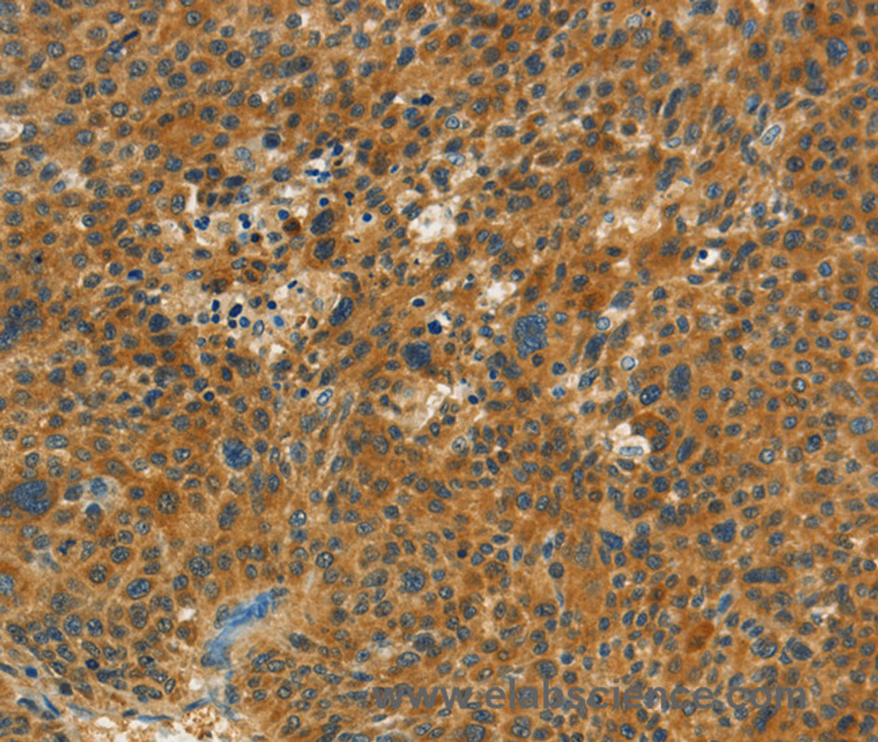 Immunohistochemistry of paraffin-embedded Human liver cancer tissue using NPAP1 Polyclonal Antibody at dilution 1:60