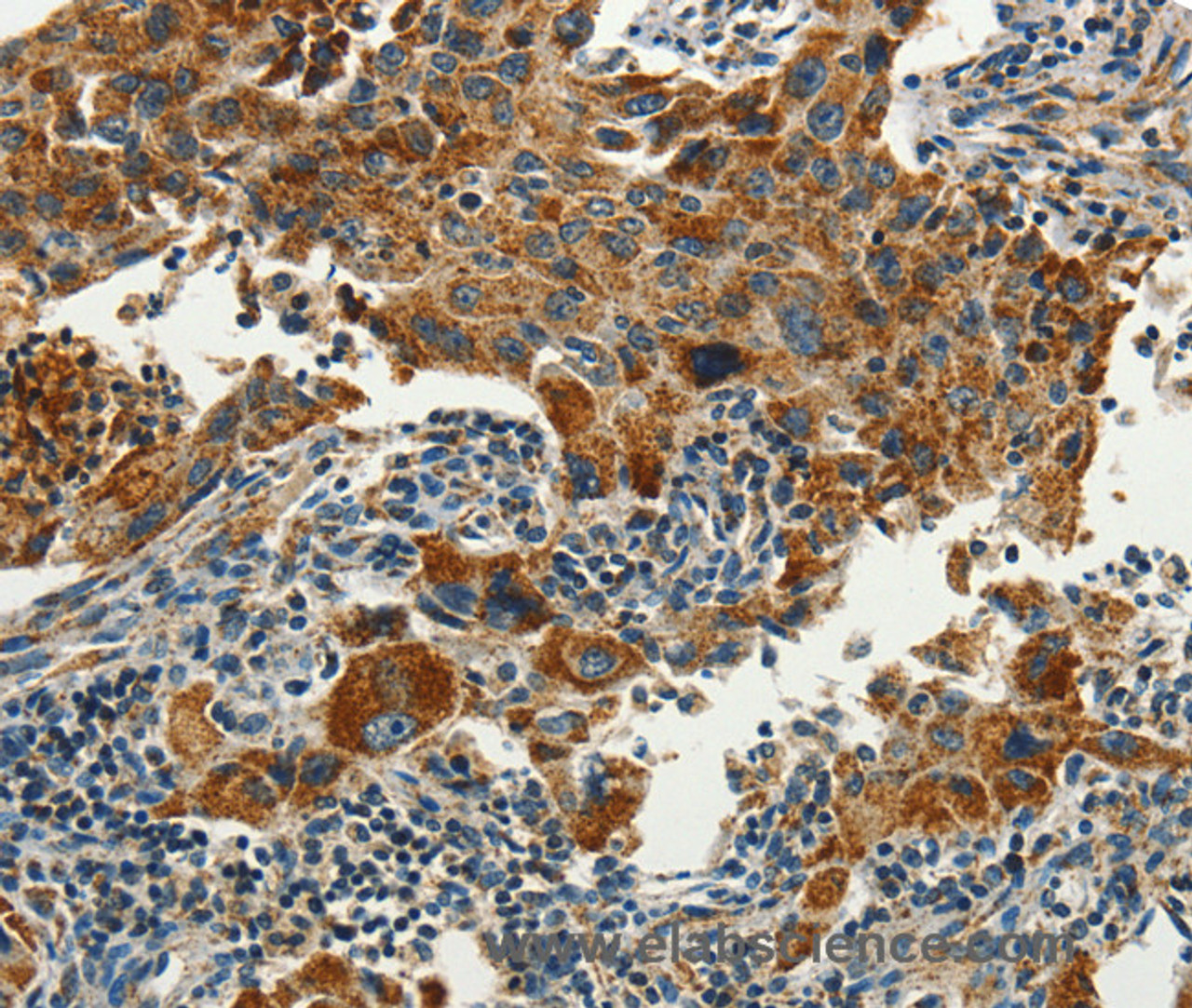 Immunohistochemistry of paraffin-embedded Human lung cancer using SERPINA9 Polyclonal Antibody at dilution of 1:60