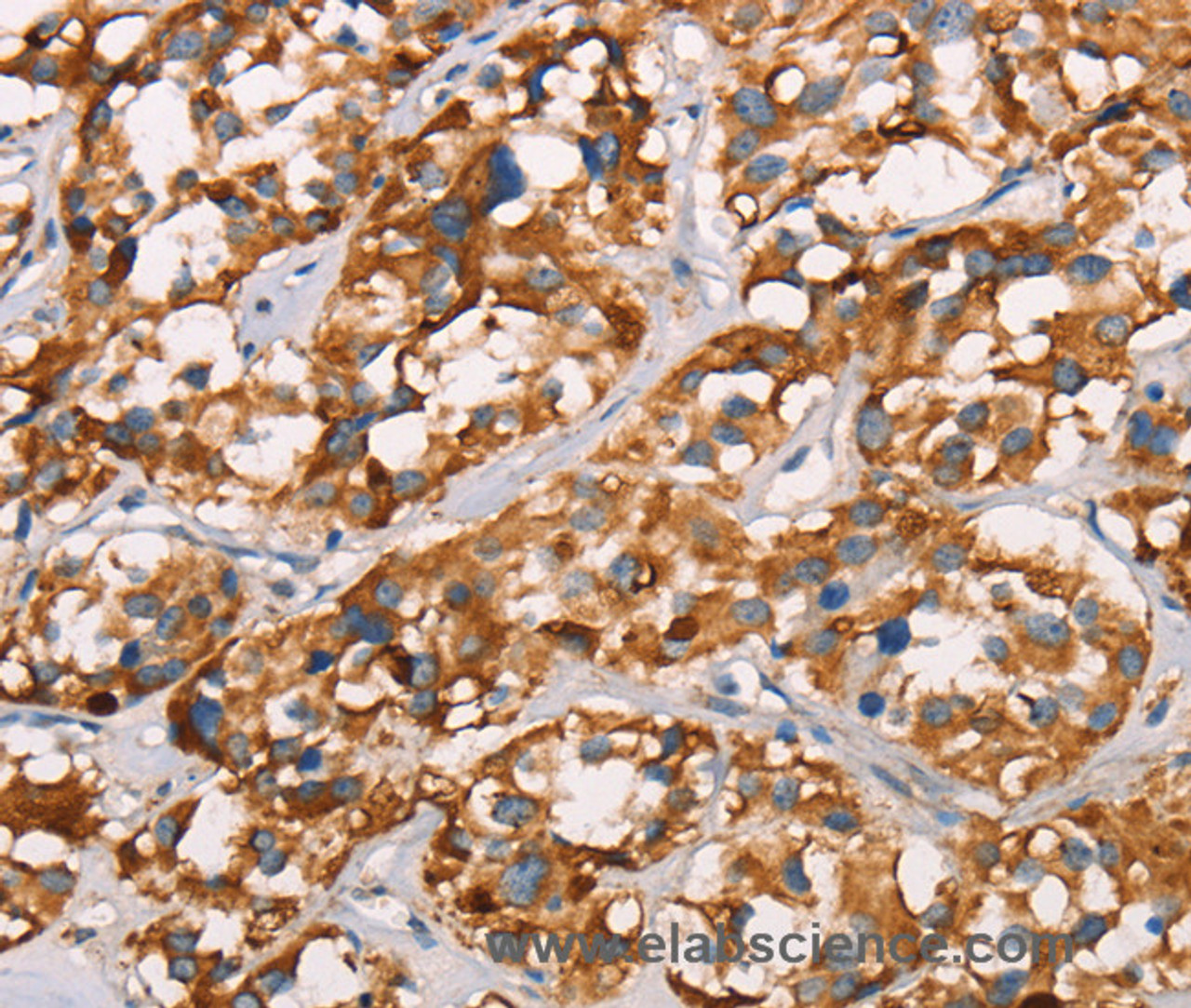 Immunohistochemistry of paraffin-embedded Human thyroid cancer using SPR Polyclonal Antibody at dilution of 1:40