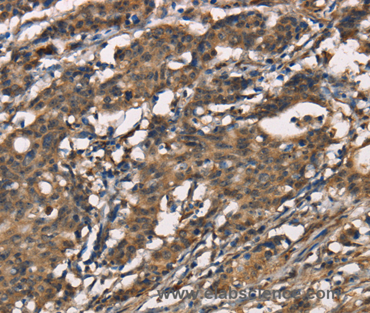 Immunohistochemistry of paraffin-embedded Human gastic cancer using SENP1 Polyclonal Antibody at dilution of 1:40