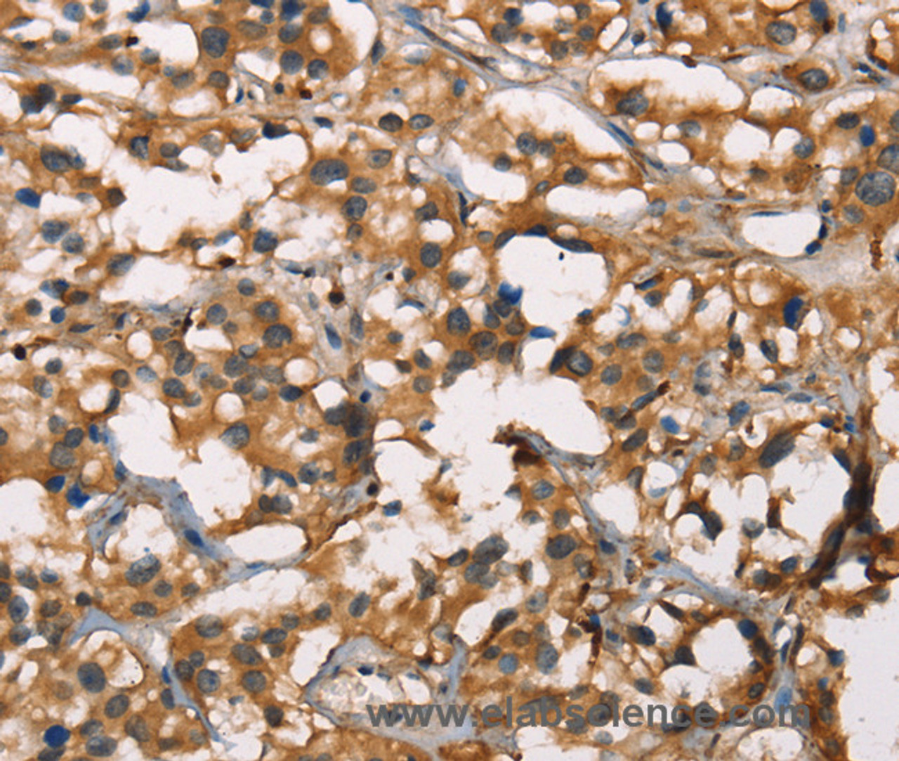 Immunohistochemistry of paraffin-embedded Human thyroid cancer using SENP1 Polyclonal Antibody at dilution of 1:40
