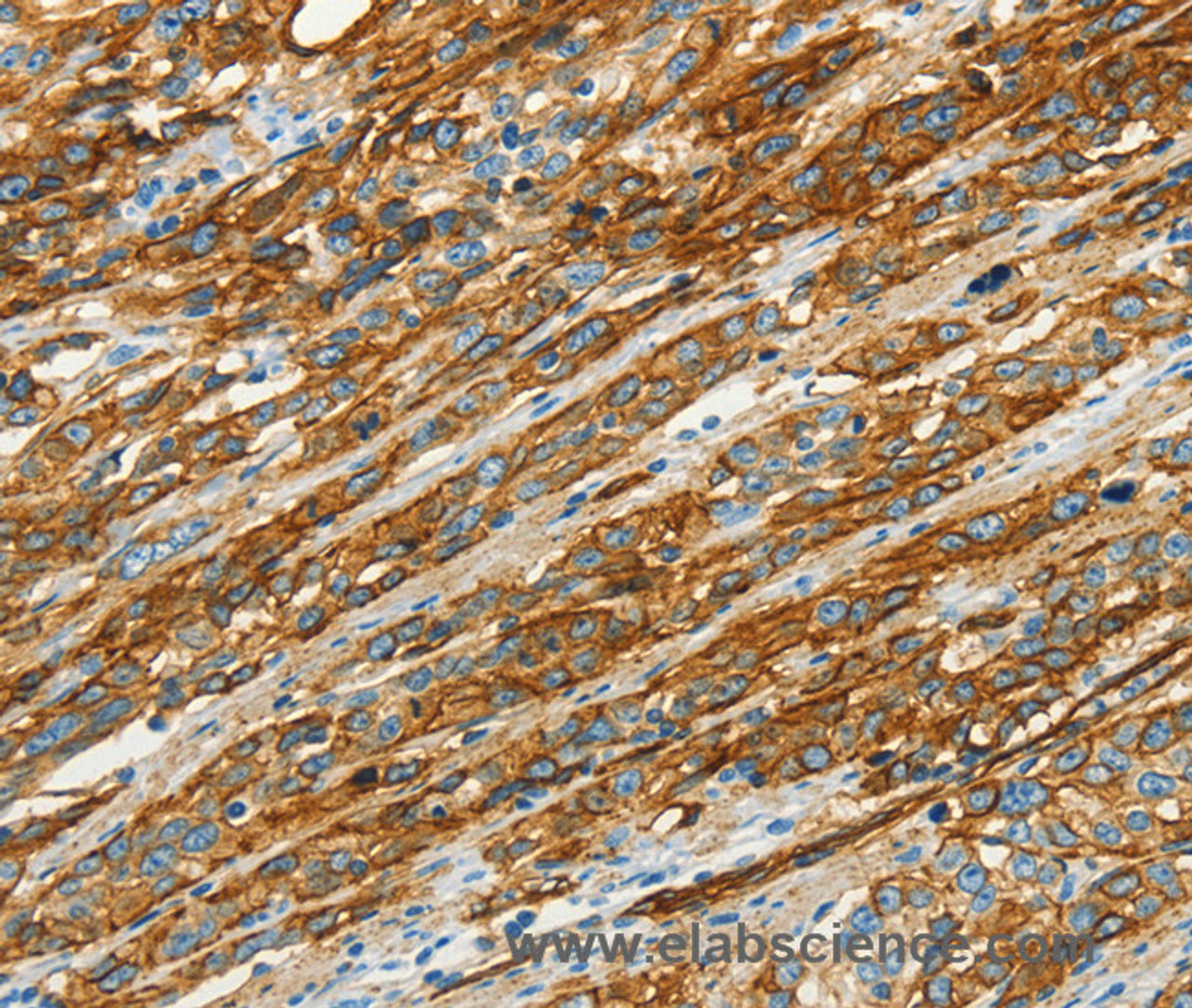 Immunohistochemistry of paraffin-embedded Human esophagus cancer using CAV1 Polyclonal Antibody at dilution of 1:40