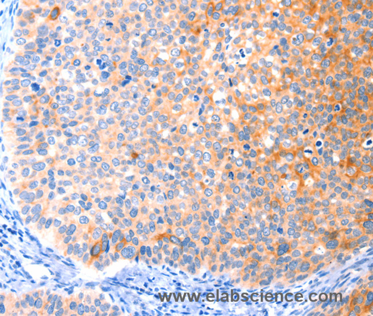 Immunohistochemistry of paraffin-embedded Human cervical cancer tissue using CCDC88A Polyclonal Antibody at dilution 1:50