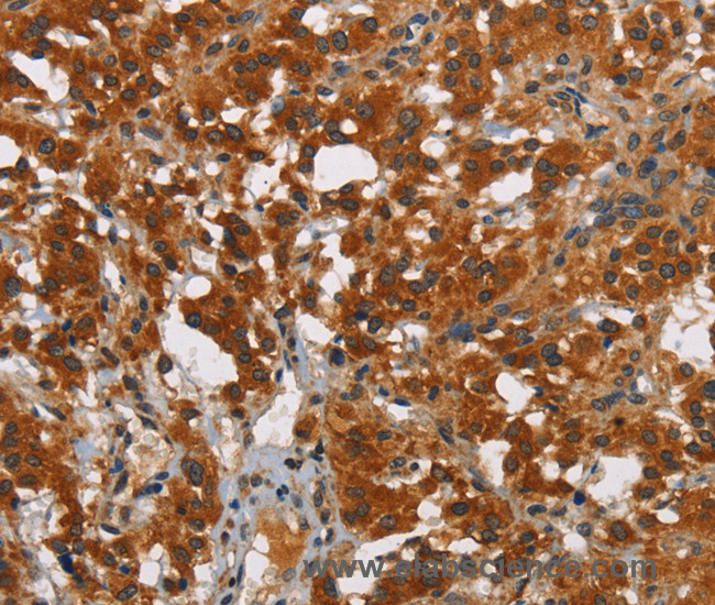 Immunohistochemistry of paraffin-embedded Human thyroid cancer tissue using SMAD9 Polyclonal Antibody at dilution 1:40