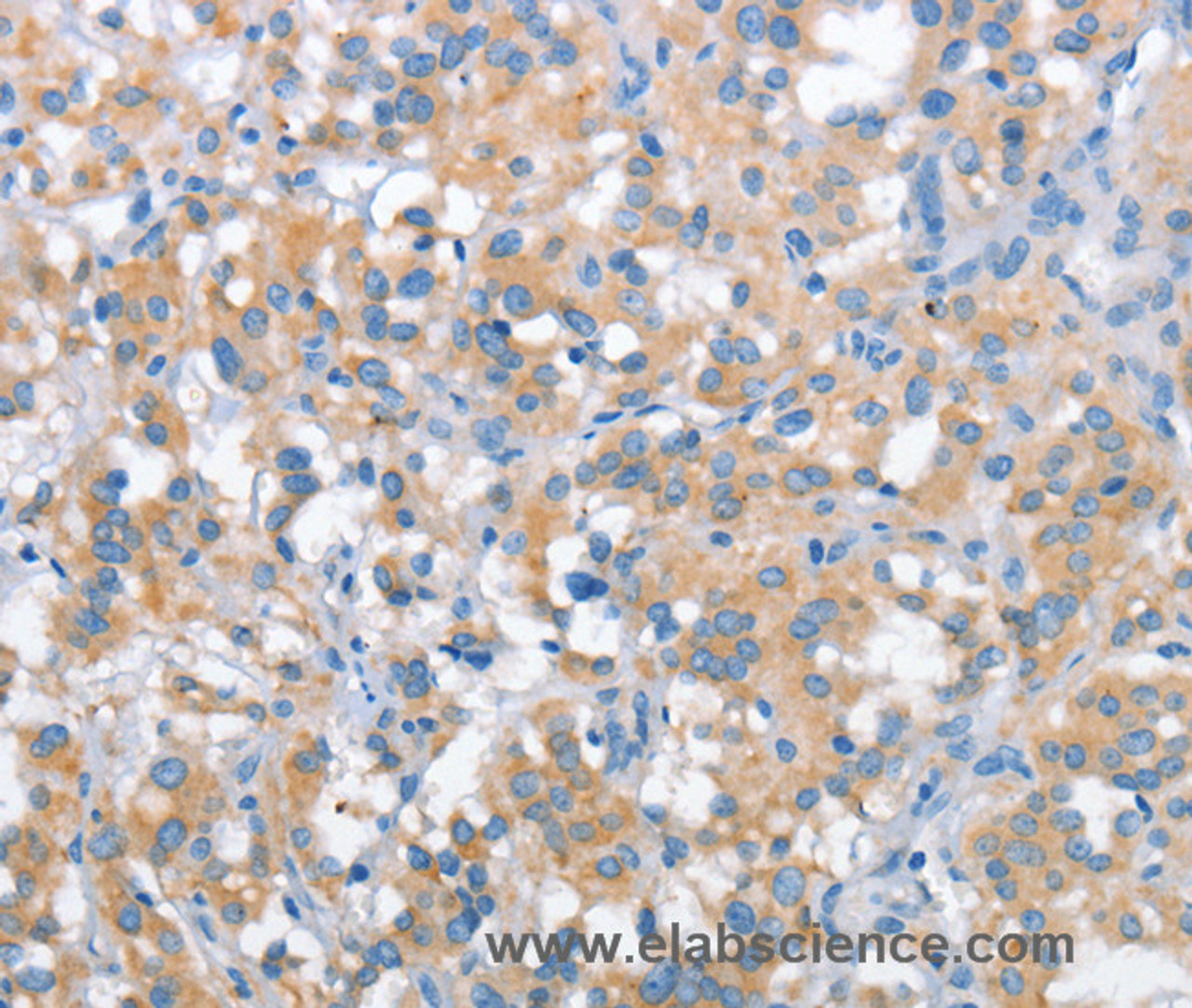 Immunohistochemistry of paraffin-embedded Human thyroid cancer tissue using SNCA Polyclonal Antibody at dilution 1:30